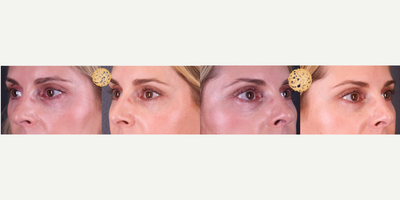 45-54 year old woman treated with Pelleve - Pelleve gives a youthful look by smoothing and removing crows feet and eye wrinkles.