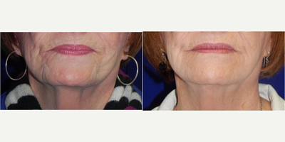 65-74 year old woman treated with ThermiSmooth - Patient is shown after receiving 3 ThermiSmooth Skin Tightening Treatments to her jawline and neck.  There is remarkable skin tightening and wrinkle reduction to the jowls, chin and neck.