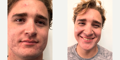 18-24 year old man treated with AviClear - 6 sessions of Aviclear & 5 sessions of Xeo genesis laser.