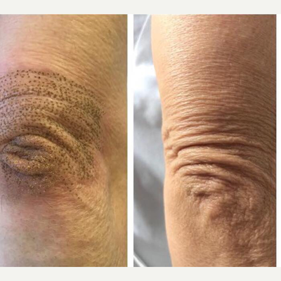 45-54 year old woman treated with Laser Treatment - Plasma Fibroblast Elbow Treatment