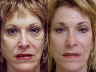 64 year old female with loss of volume in face - 64 year old with previous history of face lift 15 years ago. Now problem was deflation rather than loss of skin elasticity. She had two sessions of Sculptra injections, first with 14 ml, then with 10 ml. Note under eyes, softness of features, lateral to chin.