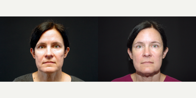 55-64 year old woman treated with ArteFill - 55 year old female received 2 syringes of Bellafill to the cheeks; photos depict the patient's results 3 months post-treatment.