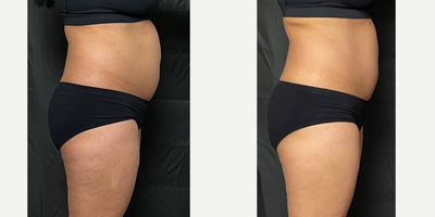 45-54 year old woman treated with Emerald Laser NOT Zerona this is the newest low level light fat reduction laser by Erchonia - Real Self does not have Emerald Laser Treatment as an option but Zerona is the previous version with red light this is the newer 25% more effective green diode laser.Patient had 10 total treatments over ~ 5 week period. Typically 2 sessions/week.