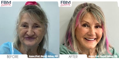 65-74 year old woman treated with Deep Plane Facelift, Neck Lift, Double Eyelid Surgery, Lip Lift, Rhinoplasty, Facial Fat Trans - .