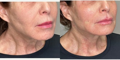 65-74 year old woman treated with Cheek Fillers, Liquid Facelift, Lip Fillers, Miracu, Nonsurgical Facelift, Radiesse, RHA Colle - Facial Rejuvenation in the hands of Dr. Jeffrey Rosenthal, requires a combination of procedures to stimulate collagen with the Endolift Laser, Lift and support sagging face, jaw and neck skin with PDO Threads (Miracu and Mint) and replace lost volume with Radiesse and RHA fillers. Harmony and Balance of the face and neck is the ideal rejuvenation.