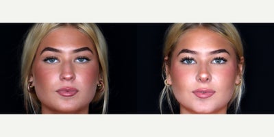 19 year old woman treated with Septoplasty, Rhinoplasty - 19 year old woman treated with Septoplasty, Rhinoplasty Photos depict before and 1 month after surgery