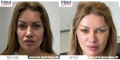 35-44 year old woman treated with Brow Lift, Eyelid Surgery - 35-44 year old woman treated with Brow Lift, Eyelid Surgery