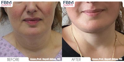 45-54 year old man treated with Neck Lift, Lower Facelift - 45-54 year old man treated with Neck Lift, Lower Facelift