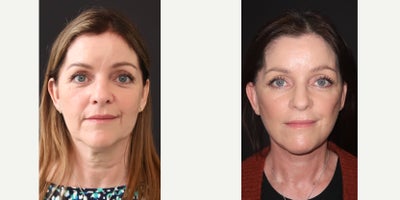 55-64 year old woman treated with Deep Plane Facelift, Facelift, Neck Lift, Earlobe Repair, Drainless Tummy Tuck - Extended deep plane facelift and deep neck lift and submandibular gland reduction, earlobe reduction.