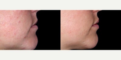 29year old woman treated with Volbella - 29year old woman treated with Volbella, Lip Fillers. Photos depict before and 2 weeks after treatment.