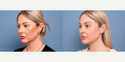 36 year old woman treated with MyEllevate - 36 year old woman treated with MyEllevate with 15 cc liposuction to neck. Photos depict before and 6 weeks after surgery.