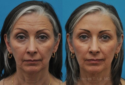 Aging face rejuvenation with Botox and Filler - 
	Female who complained of tired and worried appearance&nbsp;underwent nonsurgical aging face rejuvenation with Botox to forehead and a small amout of filler (Belotero) to lower face. Patient is in her early 60s in age.
