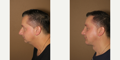 35-44 year old man treated with Chin Implant - rhinoplasty, mini neck lift and chin augmentation