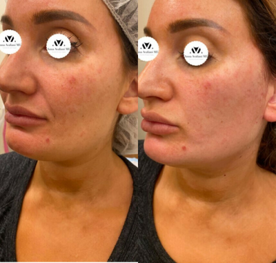 25-34 year old woman treated with Nonsurgical Facelift, Thread Lift, NovaThreads - Instant thread lift result in a 30 y.o Female patient. The results vary based on proper patient selection and properly performed treatment