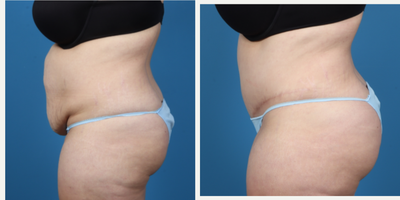 45-54 year old woman treated with Tummy Tuck, Liposuction - ABDOMINOPLASTY. LIPOSUCTION BILATERAL HIPS AND FLANKS