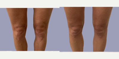 35-44 year old woman treated with Morpheus8 - 35-44 year old woman treated with Morpheus8 to the Knees