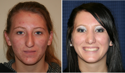 Rhinoplasty - 
	Rhinoplasty
