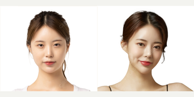 25-34 year old woman treated with Double Eyelid Surgery, Canthoplasty, Eyelid Surgery - 25-34 year old woman treated with Double Eyelid Surgery, Epicanthoplasty, Lateral canthoplasty by Hoon Song MD.And Rhinoplasty performed by other surgeon of the Girin Plastic Surgery Clinic.