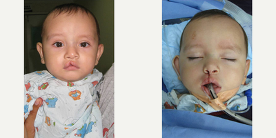 Cleft Lip And Palate Repair - This six month old boy had a unilateral incomplete cleft lip. This was repaired by Dr. Ransom.