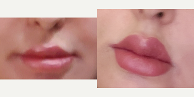 35-44 year old woman treated for lip scarring and nodules from filler injections - filler injections over time can cause nodules and scarring that can turn the lip rather inwards. such scarring is sometimes not responsive to smaller doses of Hyaluronidase enzyme whereas larger amounts can cause significant loss of soft tissues. the nodules were removed surgically, lip mucosa was advanced and patient now has rather fuller lips with original shaped being restored. its a bit swollen as its only 2 weeks but that will go down.