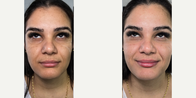 25-34 year old woman treated with Dermal Fillers, Belotero, Juvederm, Restylane - Immediate before and after undereye filler belotero balance