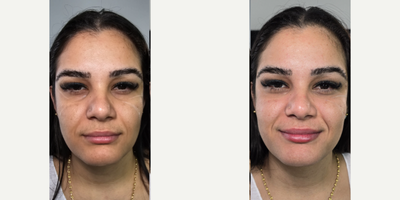 25-34 year old woman treated with Dermal Fillers, Belotero, Juvederm, Restylane - Immediate before and after undereye filler belotero balance
