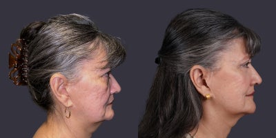 65-74 year old woman treated with Eyelid Surgery, CO2 Laser, Facial Fat Transfer, ActiveFX - This 69 year old woman presented requesting improvement in her tired eyes. She had upper eyelid blepharoplasty, lower eyelid blepharoplasty with fat transposition, and CO2 laser resurfacing around the eyes.