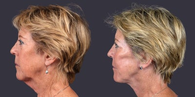 65-74 year old woman treated with Facelift, Eyelid Surgery, CO2 Laser, Skin Rejuvenation, Lower Facelift, Neck Lift, SMAS Faceli - This 68 year old woman is 5'2 and 129 pounds. She presented requesting facial rejuvenation. She had a deep plane - SMAS facelift and neck lift, lower eyelid blepharoplasty, corner of the mouth lift, and central face skin rejuvenation with CO2 laser resurfacing.