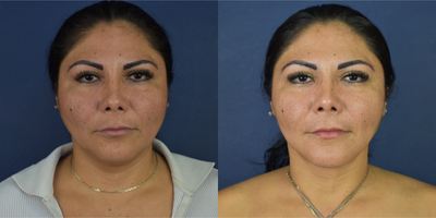 35-44 year old woman treated with Neck Lift, Buccal Fat Removal, Chin Liposuction, Micro Botox - This female patient treated with Deep Necklift, buccal fat removal and facial lipo. She has a jowl line reshaping and more facial definition.