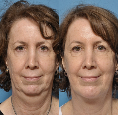ThermiTight Neck and Jowls, Neck Liposuction, Silastic Chin Implant  - This patient was concerned with her sagging neck and jowls coupled with her weak chin. She was not ready for a facelift and elected to undergo ThermiTight for her neck and jowls, neck liposuction, and a silastic chin implant (medium size).