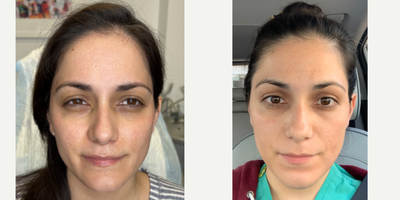 ADIEU ACNE SCARS - Our patient has suffered from severe acne scars across multiple regions of her face for a long time. She wants to look and feel her best, so she came to us to significantly diminish the scarring and improve the overall quality of her skin. We gave her a combination treatment that included TCA cross, Pixel, and the CLEAR AND BRILLIANT laser treatment. TAG A BEST FRIEND WHO MAY WANT THIS TREATMENT 