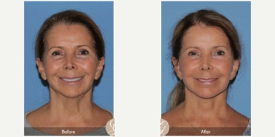 69 year old woman treated with Deep Plane Facelift, Facelift, Neck Lift, Dermal Fillers, MACS Facelift - 69 year old woman treated with Deep Plane Face and Neck Lift, Filler to the Temples and Chin, Laser to Face MAC