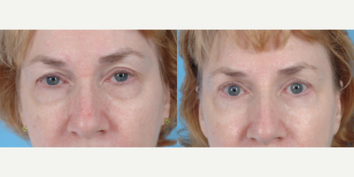 55-64 year old woman treated with Eyelid Surgery - A 60 year old woman before and after Upper and Lower Lid Blepharoplasty by Andrew T. Lyos M.D FACS.