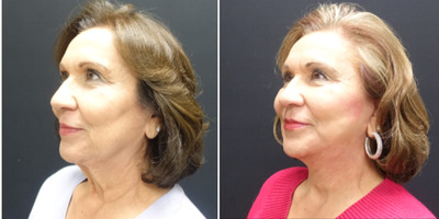 65-74 year old woman treated with Fat Transfer and Facelift - The patient underwent a high lateral SMAS face and necklift. The SMAS elevation supports the facelift so that their is minimal tension on the skin and enhance the possible longevity of the face and necklift. Along with the face and necklift she also had fat transfer to the face. Fat was transferred tough out the face and temples to restore the volume she has lost over time as we age. The combination of tightening and filling of the face gives her a much more youthful but natural appearance. This pictures show her two month result.