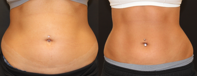 18-24 year old woman treated with Emsculpt - Four Sessions of EMSCULPT to the abdomen.