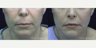 35-44 year old woman treated with Lip Lift - 35-44 year old woman treated with Lip Lift