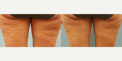 25-34 year old woman treated with Laser Treatment - Treated with Body FX laser contouring system.