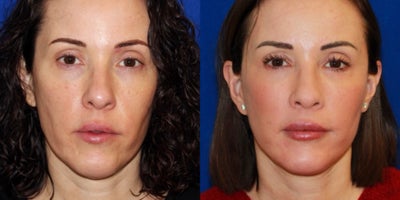35-44 year old woman treated with Mini Facelift, Neck Lift - This patient was concerned with the beginning of the aging signs - slight skin laxity in the lower face and neck area. She was treated with a mini face and neck lift procedure to achieve a defined jawline profile and get rid of the lax skin under the chin.