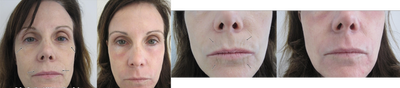 SmartXide Fractional CO2 Resurfacing - 
	Before and After SmartXide Fractional CO2 Resurfacing. Only one treatment has been performed.

