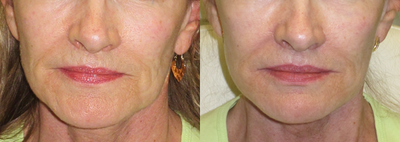 60 Year Old Female - Pt had Juvederm to perioral area