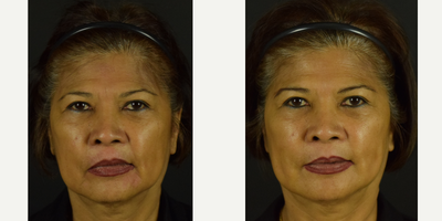 Facial Rejuvenation with Novathreads - This patient was looking for subtle lifting to the areas around her nose and mouth so as to not look overdone. The NovaLift was able to provide such results for her as shown above. Results demonstrate immediate afters to lift the cheeks and lower third, softening her smile lines and the corners of her mouth. The great features of the polydioxanone (PDO) Novathreads allowed for significant improvement to the jawline, providing more definition to the area. Overtime, these threads are reabsorbed within the facial tissues and stimulate collagen production.