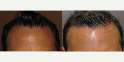 35-44 year old man treated with Hair Transplant - 35 yo male ARTAS robotic hair restoration 2500 grafts