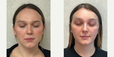 25-34 year old woman treated with Brow Lift, Brow Bone Reduction, Forehead Reduction, Facial Feminization Surgery, Genioplasty - This is a young lady who underwent forehead feminization, lip augmentation, chin feminization and mandibular angle reduction.