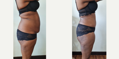 35-44 year old woman treated with Tummy Tuck, Liposuction - This 40 yo mommy who had a Tummy Tuck with Lipo 360 showing her before and 5 months after pics post op. We removed 1.5kg from her tummy and safely suctioned 3L of fat from upper tummy, flanks and back to give her a nice contour fitting to the rest of her body  including a cute new belly button and the famous Champagne Groove on the upper part of her tummy.