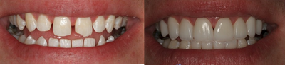 UltraVeneers - 
	UltraVeneers
