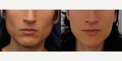 Patient treated with MTF Chin Surgery - Patient treated with MTF Chin Surgery for reduction and contouring