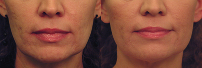 Laser Skin Tightening with acne scar improvement - Laser Skin Tightening with acne scar improvement