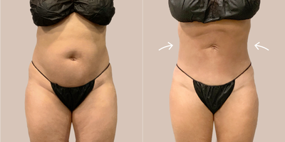 35-44 year old woman treated with AirSculpt - The patient received stomach AirSculpt and results are showing at 3 months post-op