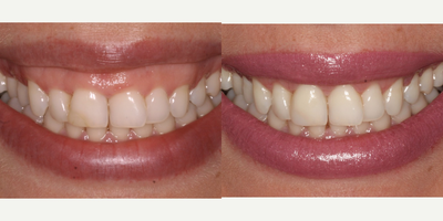 35-44 year old woman treated with Gum Lift - Surgical correction performed on female patient using full flap technique following 
by bone recontouring and tissue modification.