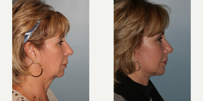 64 year old woman treated with Blue Peel - This patient had a LiteLift, Chin augmentation, Temple lift, Blue Peel, and neck lift were performed simultaneouslyon an out patient basis under general anesthesia.After photos were taken 7 months post-op.